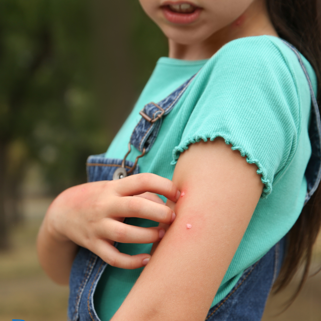 Searches For NHS Advice On Insect Bites And Stings Increase - BSW Together