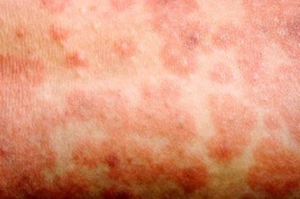 The spots of the measles rash are sometimes raised and join together to form blotchy patches. They’re not usually itchy.